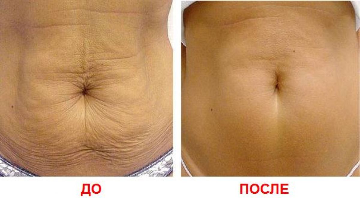 Как убрать целлюлит на животе в домашних условиях за неделю